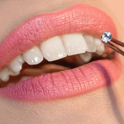 Cosmetic Tooth Gems
